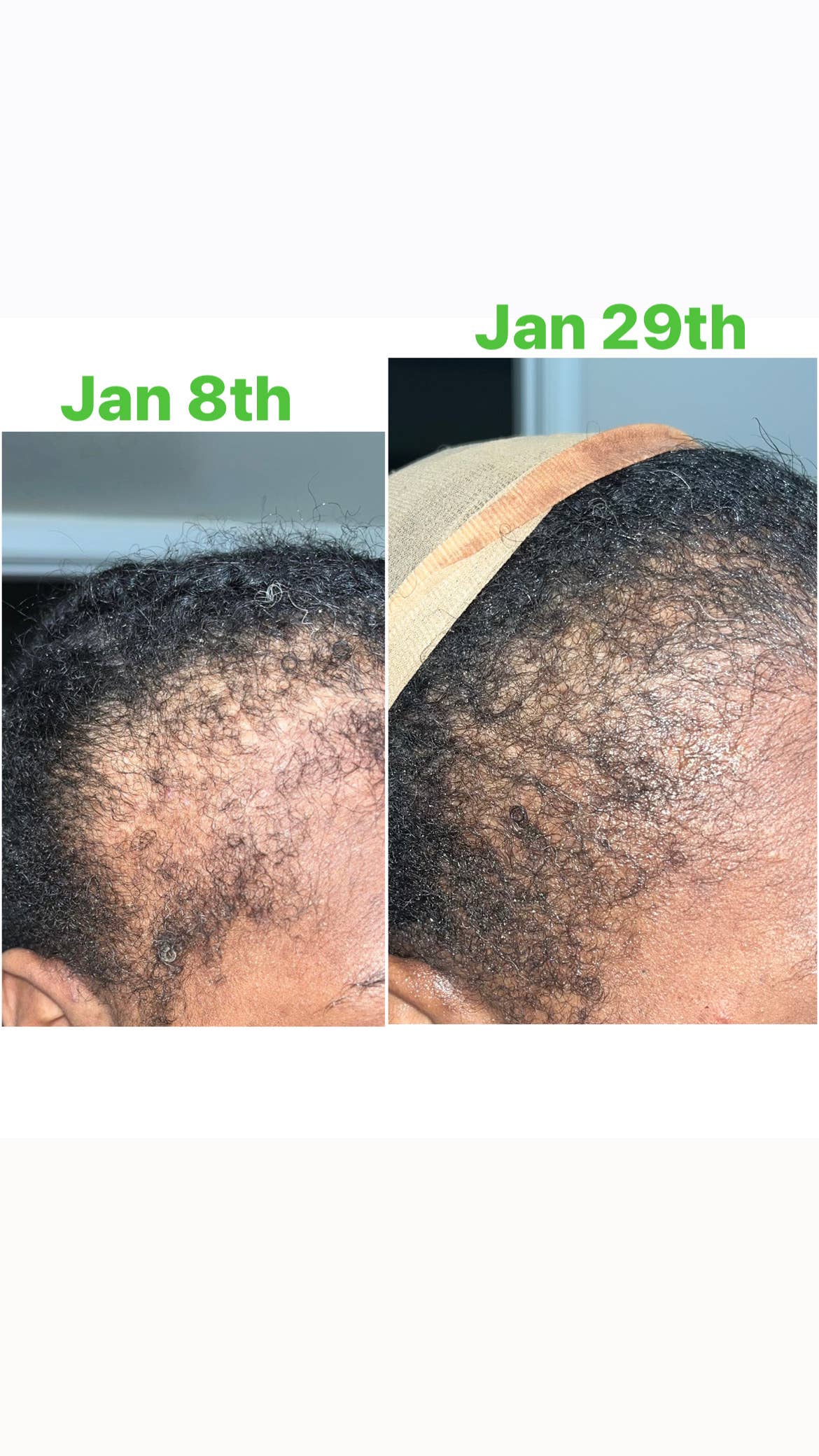 Unique Organics Haircare-40 Ingredients Alopecia Hair Oil